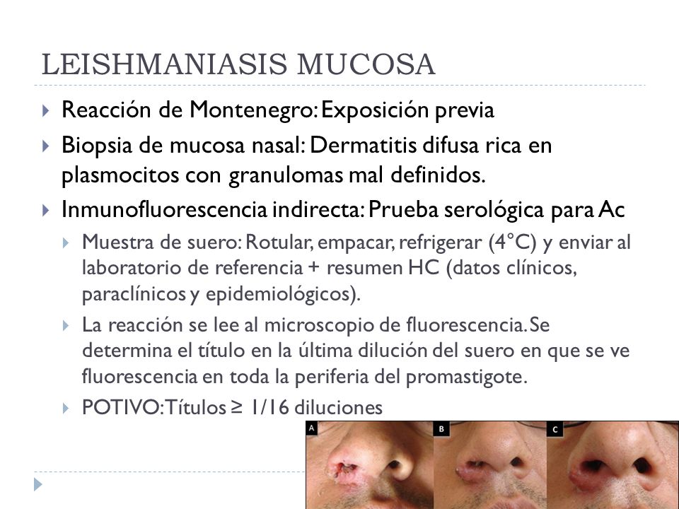 leishmaniasis cutanea laboratorio